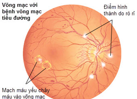 Diabetic Retinopathy: DR - Hình ảnh minh họa